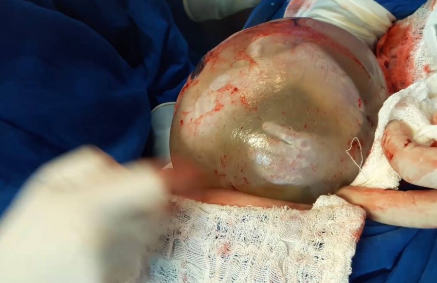Rare Twin Birth Inside Amniotic Sac