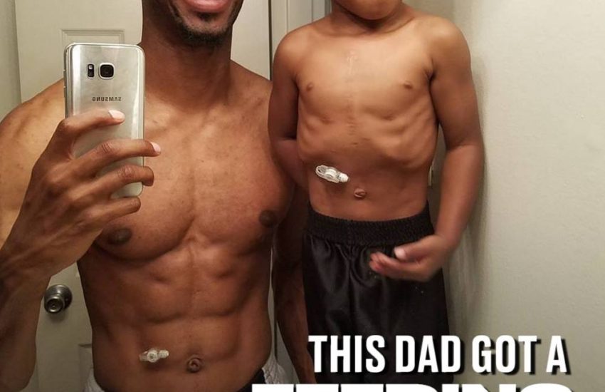 This Dad Got A Feeding Tube To Match His Son