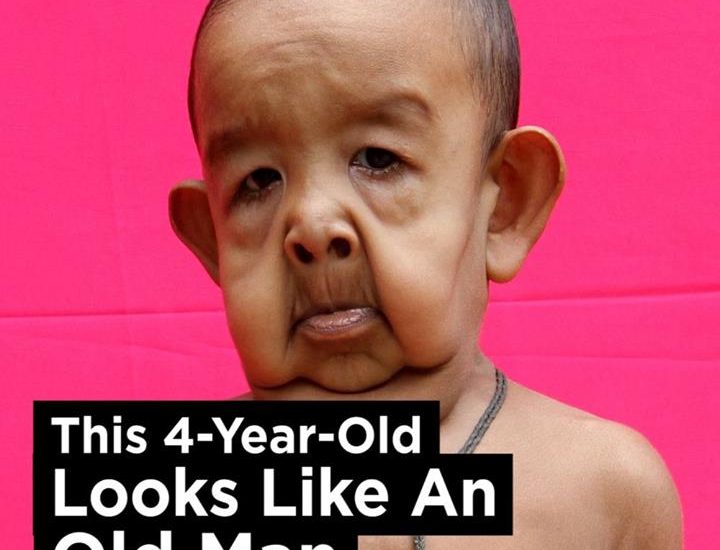 This four-year-old has a rare condition that gives him the appearance of an elderly man...