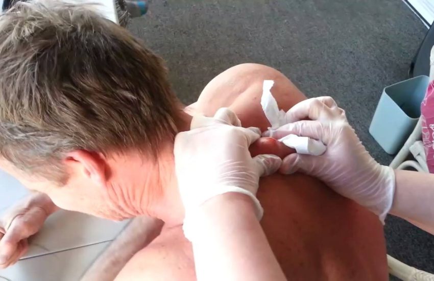 Popping A Thirty-Year-Old Cyst
